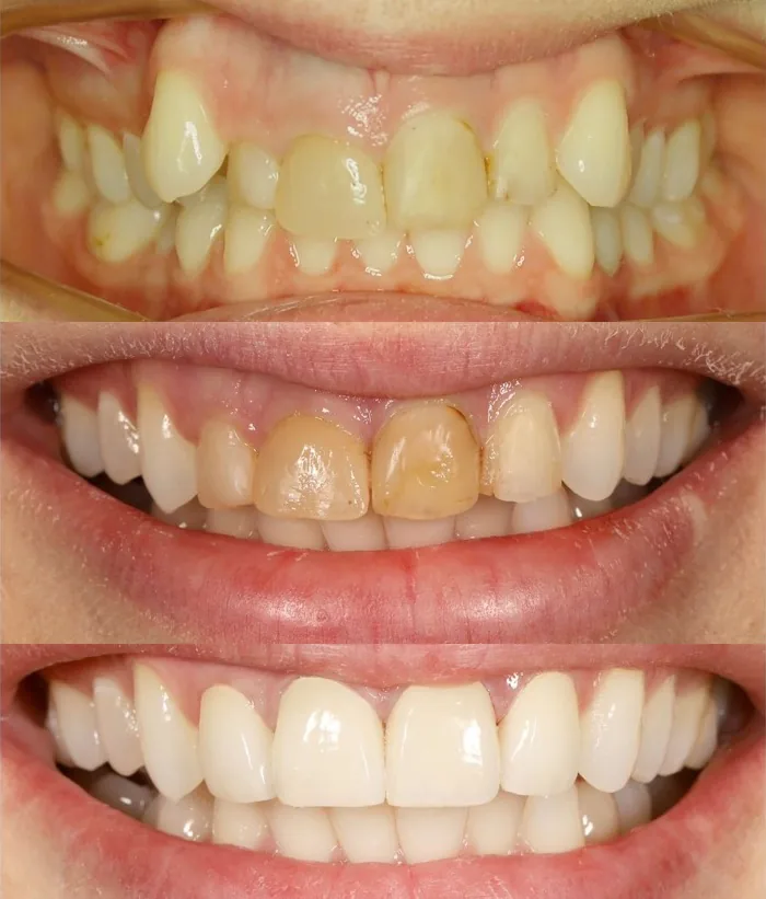 Comprehensive smile treatment, before and after