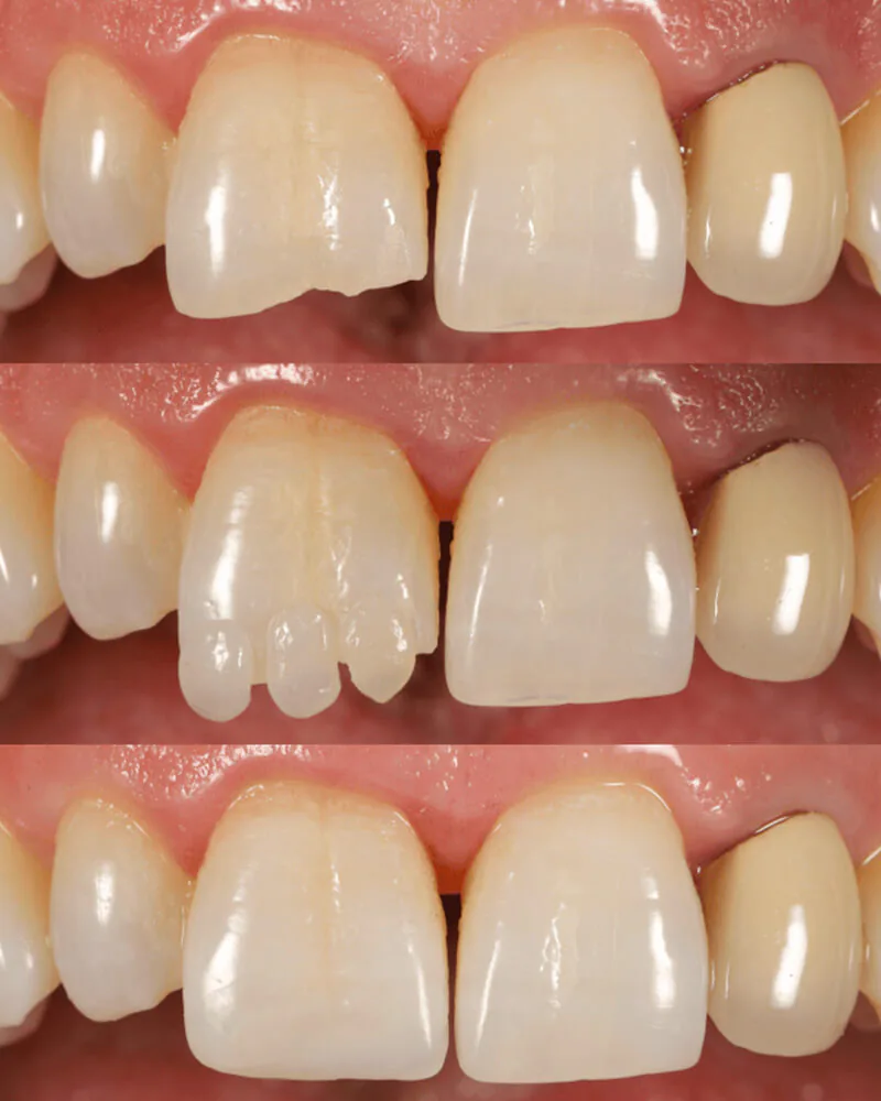 Treatment of a fractured front tooth, before and after
