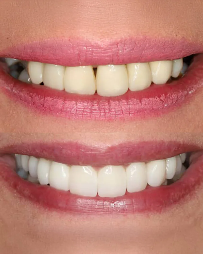 Aesthetic transformation of the upper teeth, before and after